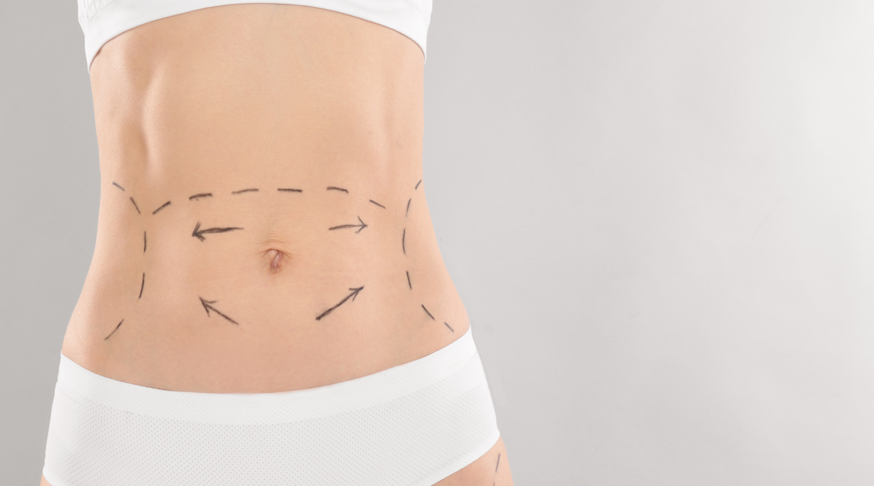 cosmetic surgery High Definition Liposuction