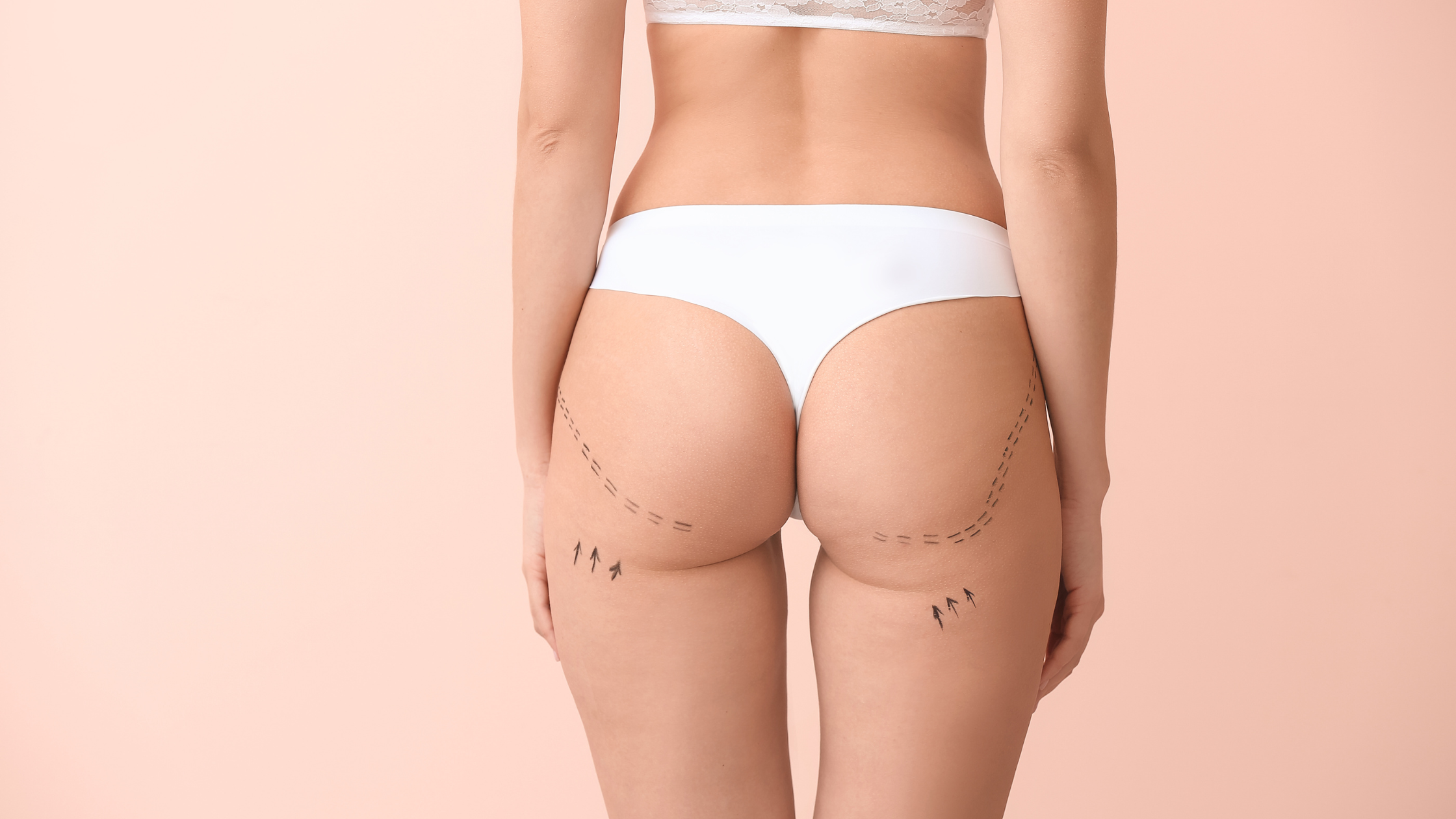 Kylie Jenner's: Did She Remove Alleged Butt Implants