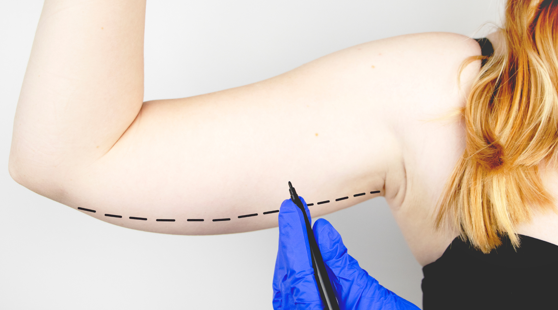 What is Liposuction? 